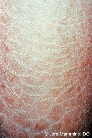 asteatosis is a sebum deficiency.